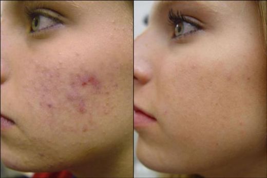  Unwanted Hair Growth, Upper Lips Hair Removal Jalandhar, Punjab in India